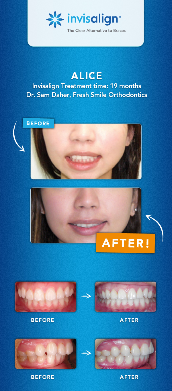 Invisalign Teen System The Result 89